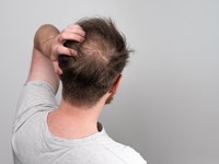 ¿Cómo combatir la alopecia?