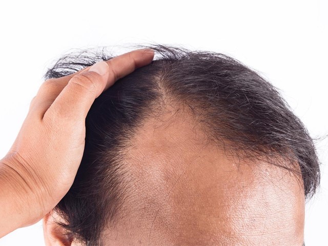 Beneficios de la crioterapia capilar