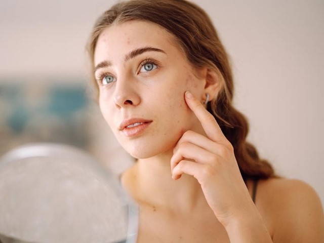 ¿Por qué tengo acné en el rostro? ¡Te ayudamos!